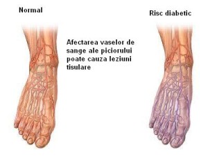 Picior Diabetic: Cauze, Diagnosticare, Simptome, Tratament & Preventie