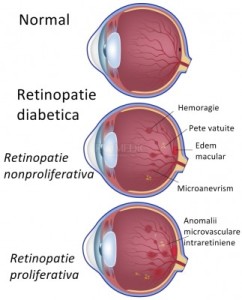 ochi-retinopatie-diabetica-dreamstimeadditional_22366003-converted_s400