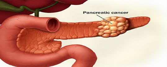 cancerul_pancreasului_03