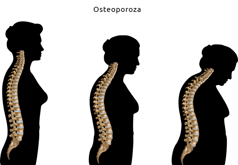 osteoporoza menopauza