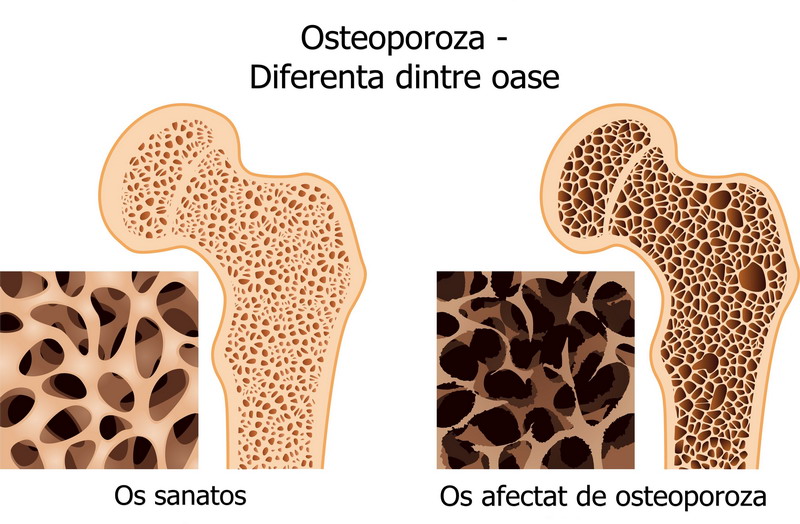 Menopauza_si_osteoporoza_3